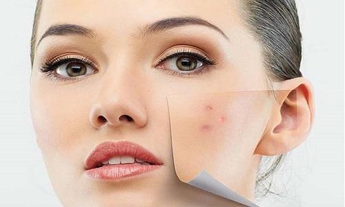 Acne Treatment Skincare by Dela  San Diego Del Mar